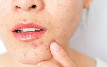 Acne Facial in Brampton at Integral Universe Wellness Clinic